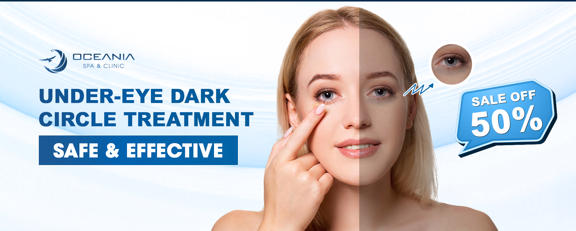 How to remove dark circles under eyes permanently