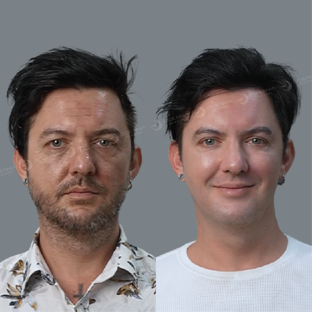 ảnh before after hifu - 07