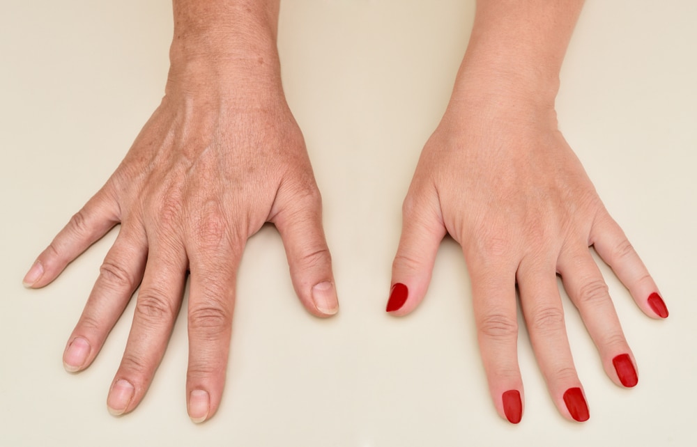 Hand Rejuvenation Treatment for Younger-Looking Hands 2