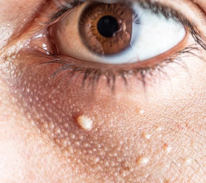 Syringoma and Milia Around the Eyes